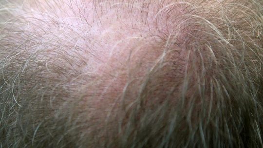 Quali sono i tipi di trapianto per capelli?