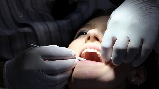 Quanto durano le faccette per i denti?